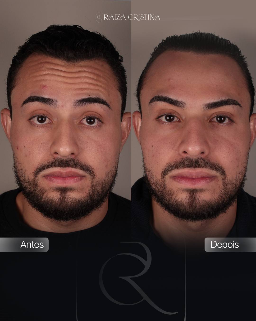 Antes e depois – post do Instagram