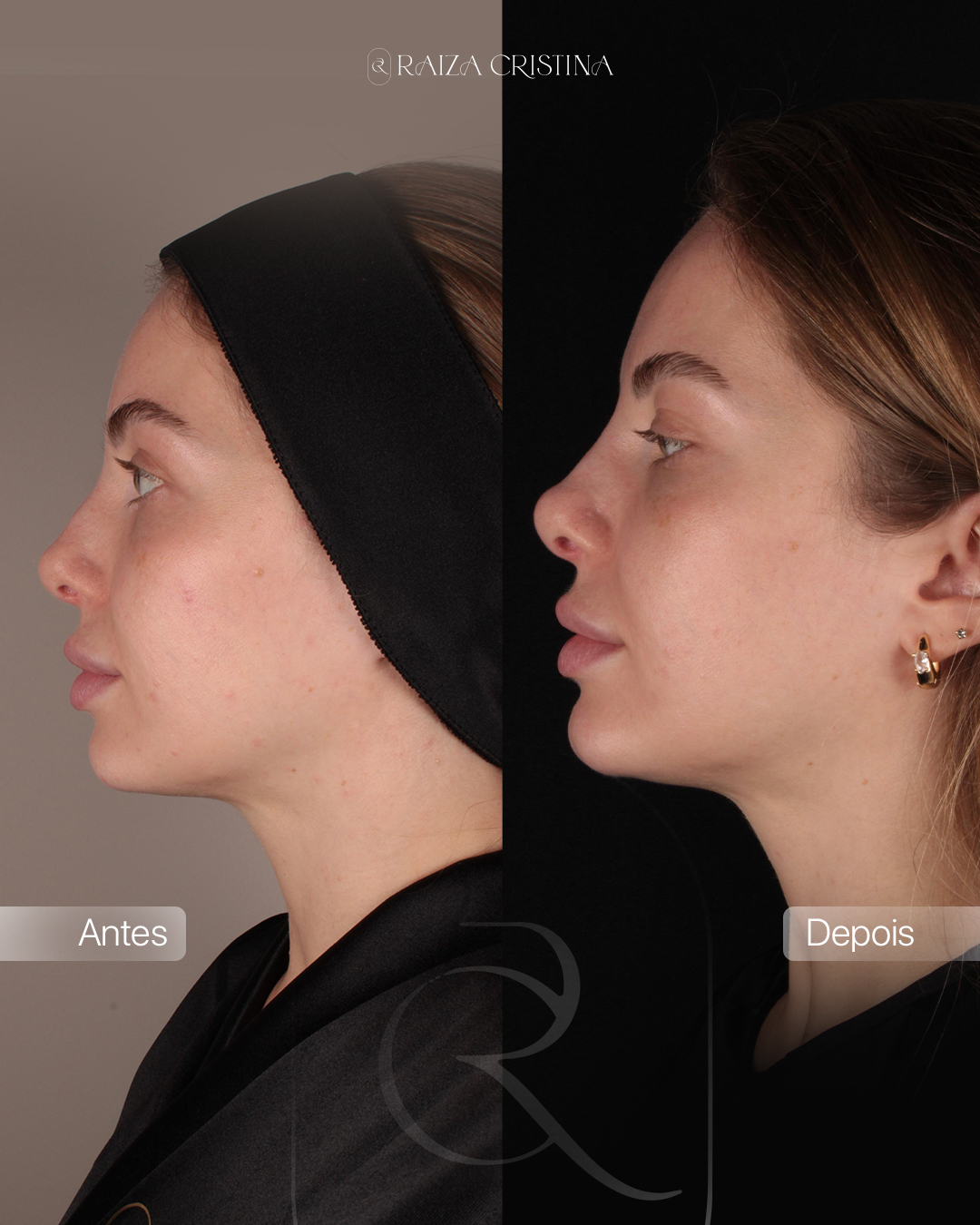 Antes e depois – post do Instagram