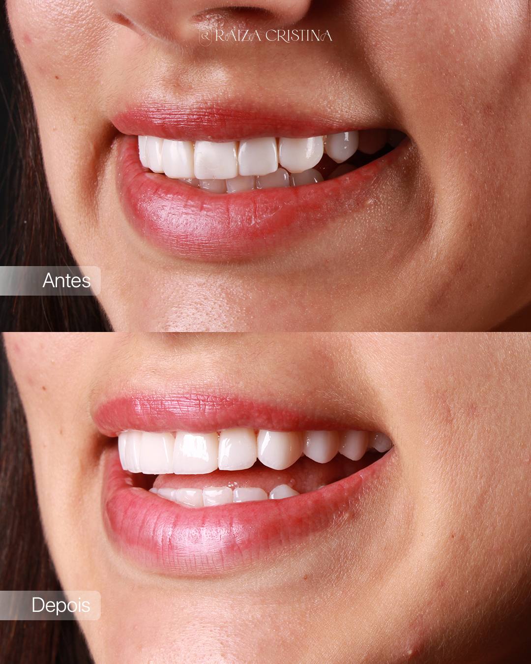 Antes e depois – post do Instagram