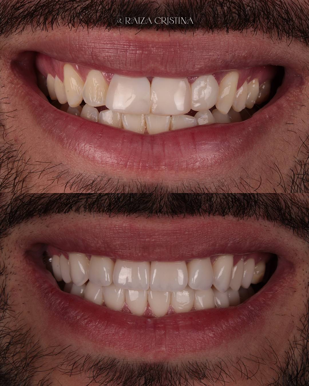 Antes e depois – post do Instagram