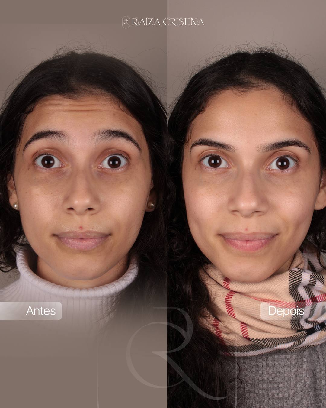 Antes e depois – post do Instagram
