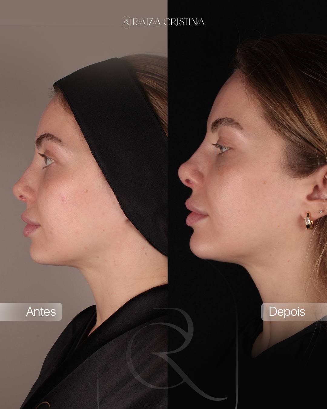 Antes e depois – post do Instagram