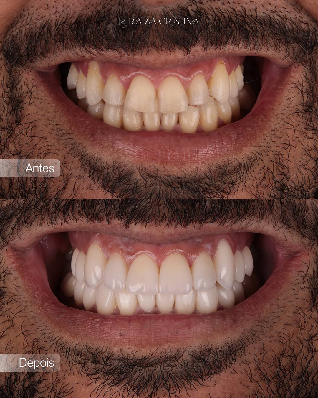 Antes e depois – post do Instagram