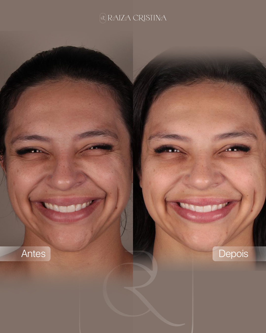 Antes e depois – post do Instagram