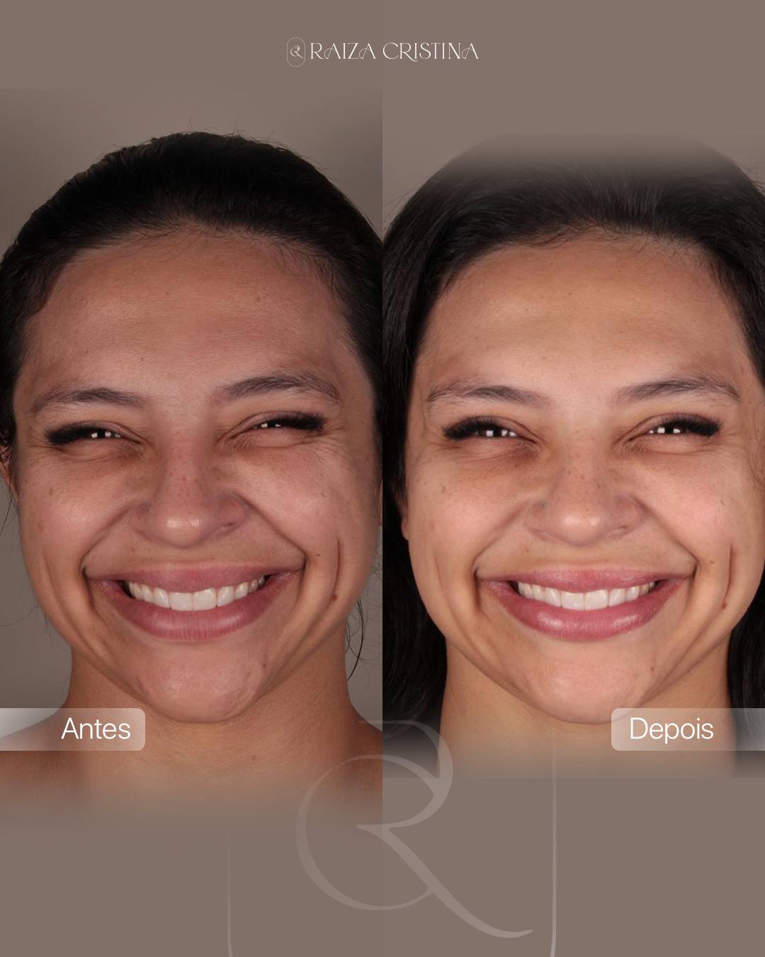 Antes e depois – post do Instagram
