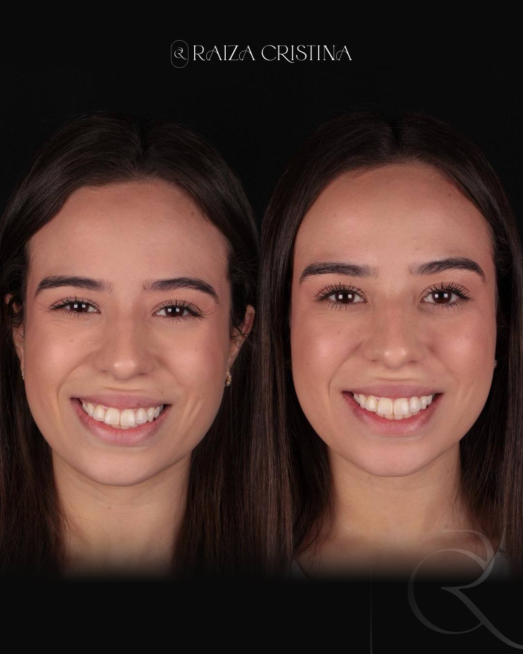 Antes e depois – post do Instagram