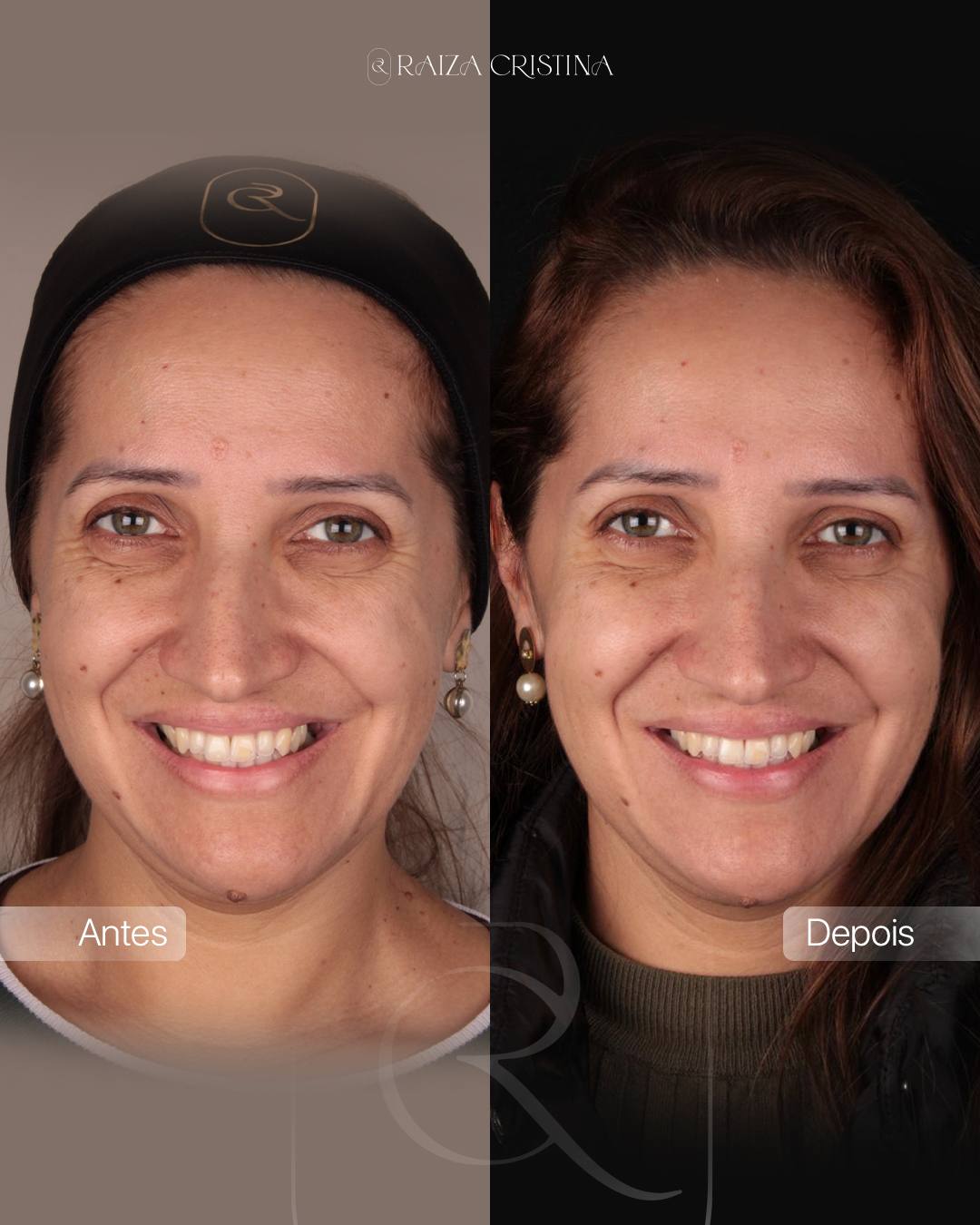 Antes e depois – post do Instagram
