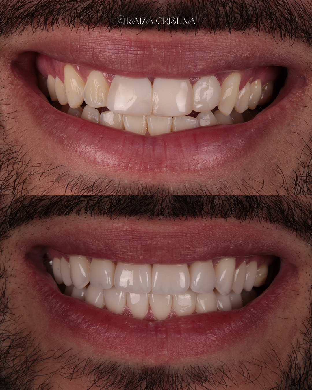 Antes e depois – post do Instagram